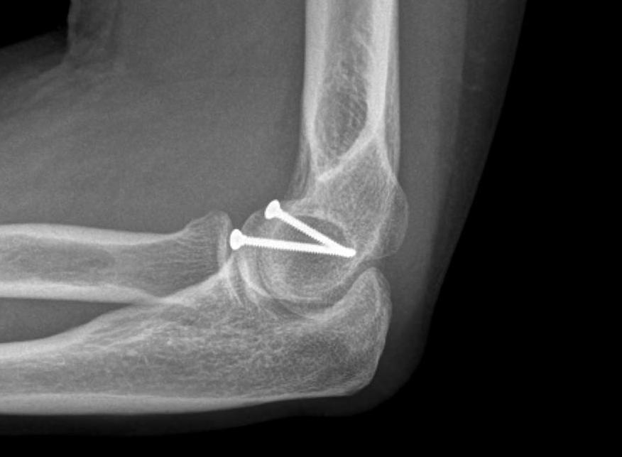 Capitellar Fracture ORIF0002